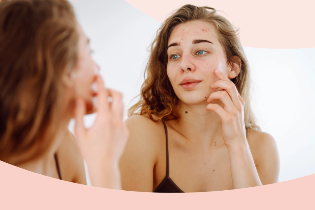 Haywards Heath Woman Shares Acne Treatment Success
