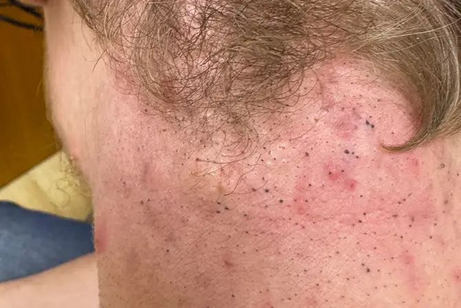 Blackheads