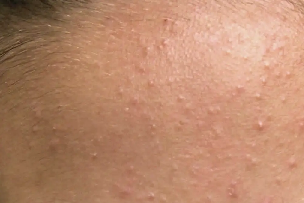 Whiteheads
