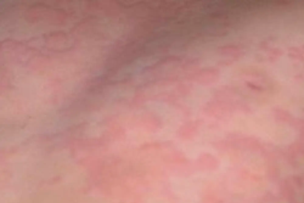 Acute urticaria
