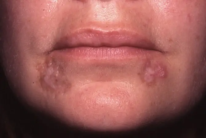 Skin rashes