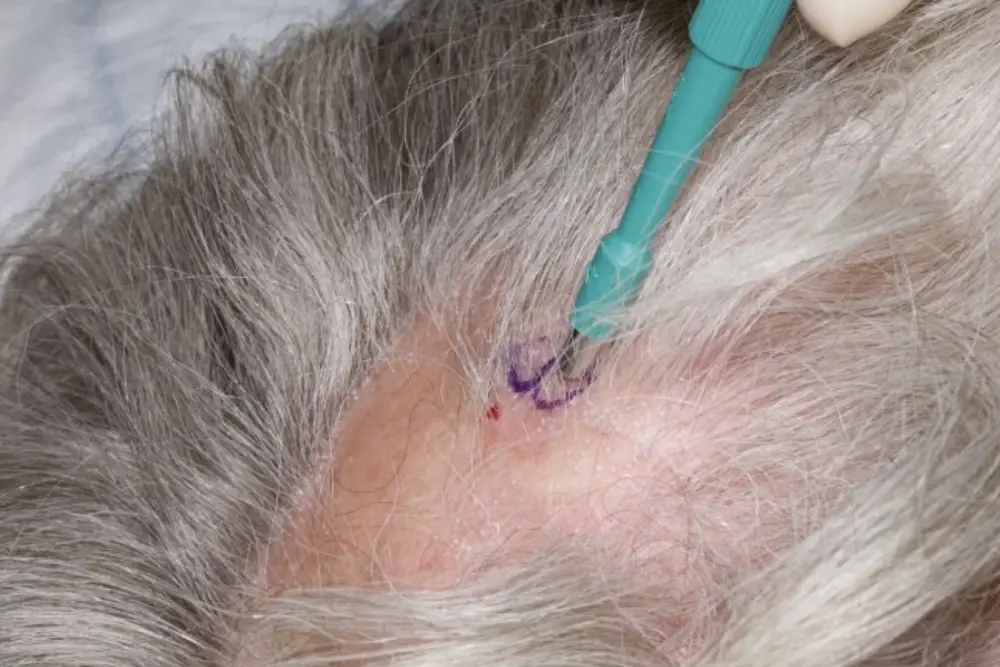Scalp biopsy procedure showing biopsy punch tool on a patient's scalp