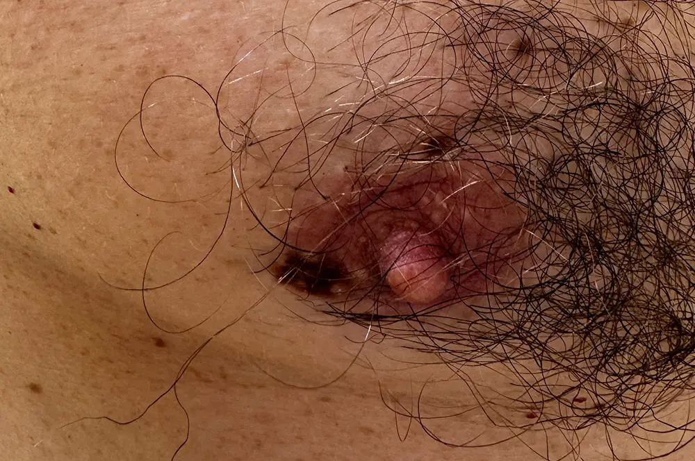 Atypical mole