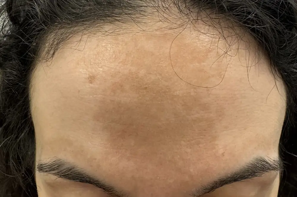 Melasma