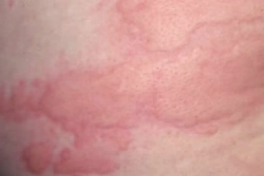 Physical urticaria