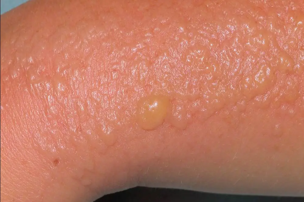 Pompholyx eczema
