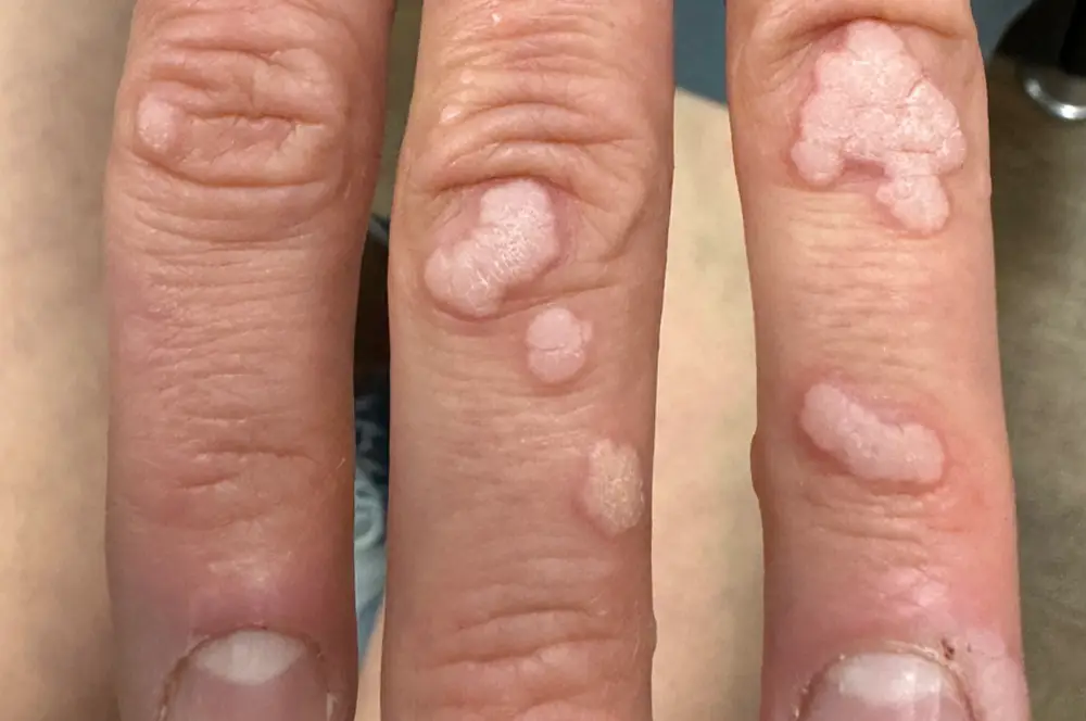 Viral Warts