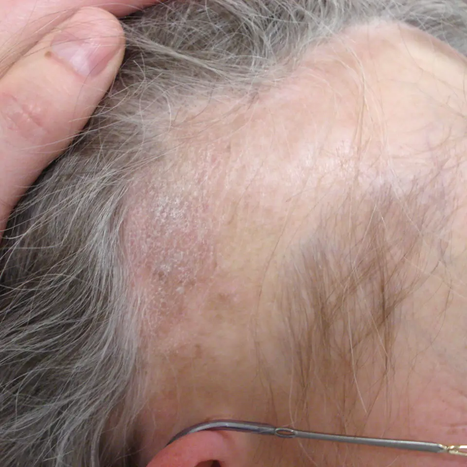 Seborrhoeic dermatitis – clinical view of scalp