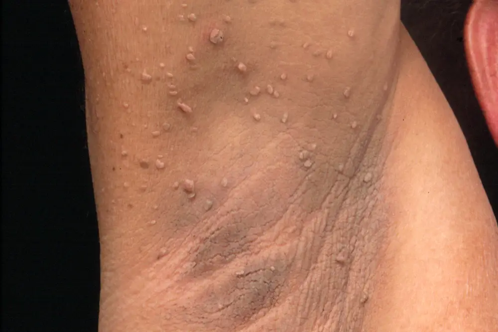 Lesions, lumps & bumps