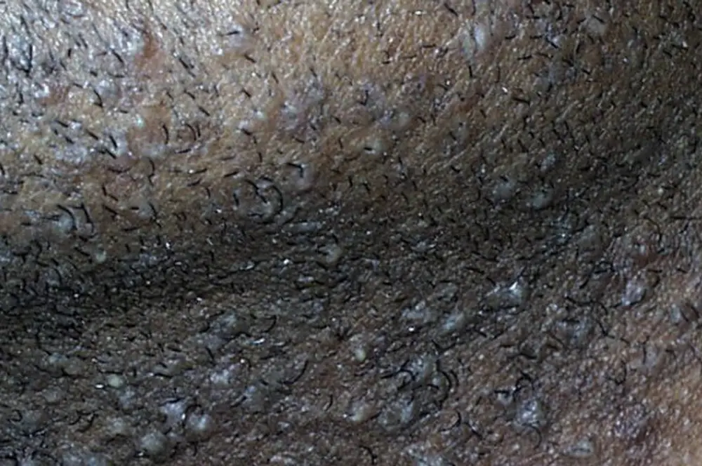 Sycosis barbae – folliculitis in beard area