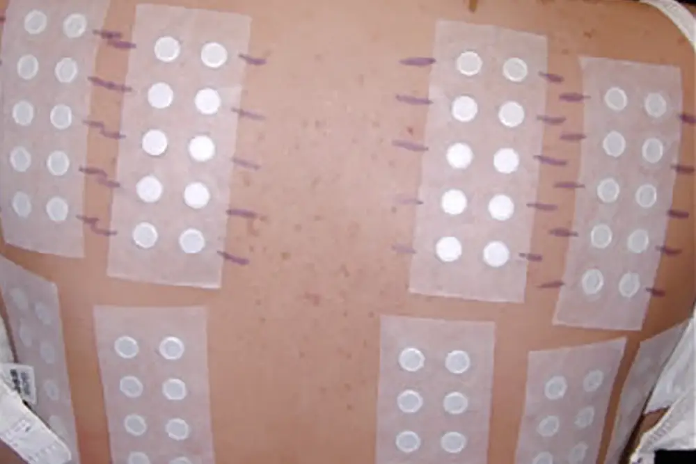 Patch testing procedure showing allergen patches applied to a patient's back