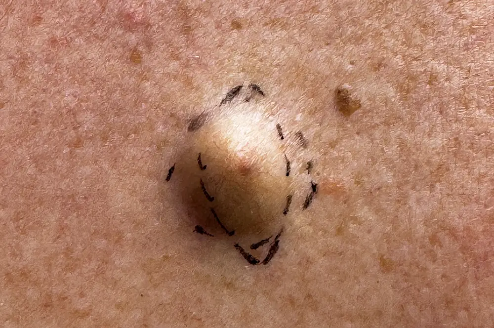 Epidermoid cyst with surgical markings