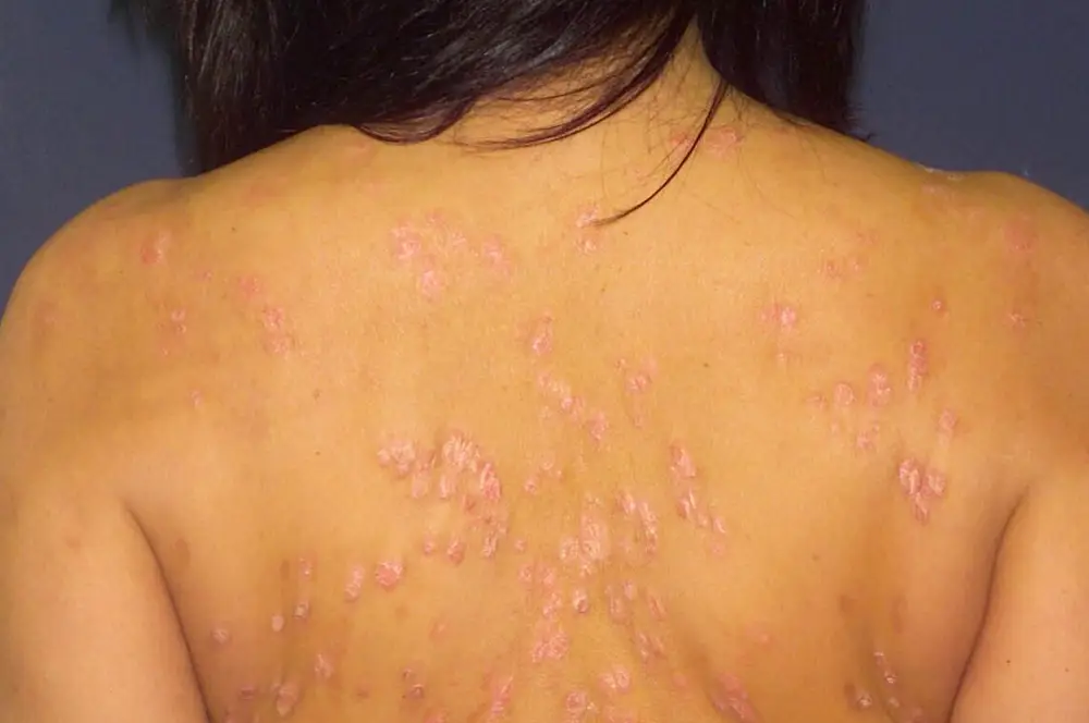 Guttate psoriasis