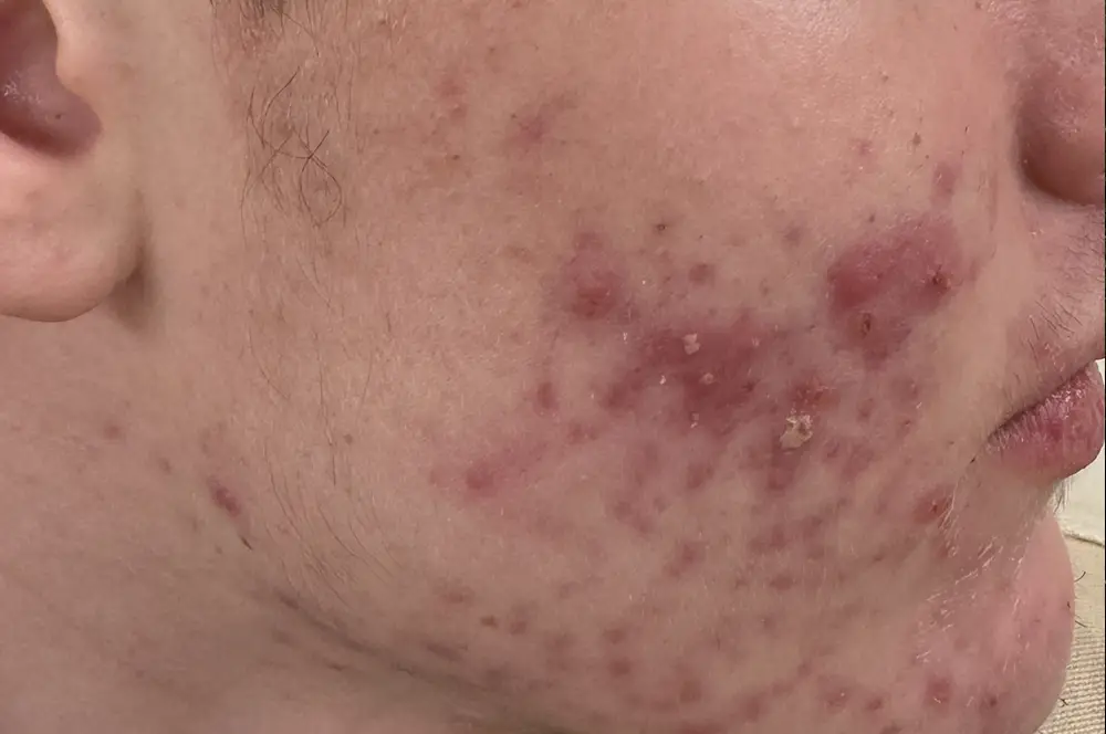 Nodules