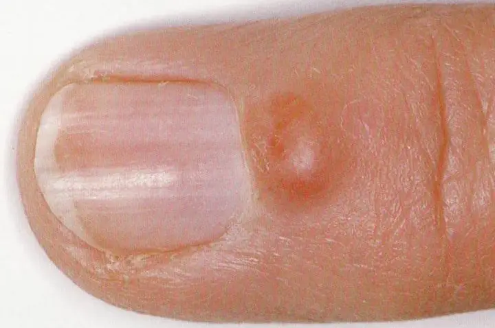 Ganglion cyst on the hand