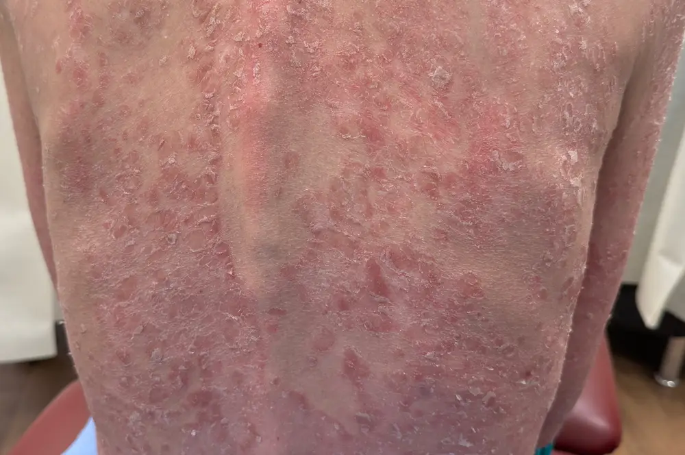 Erythrodermic psoriasis