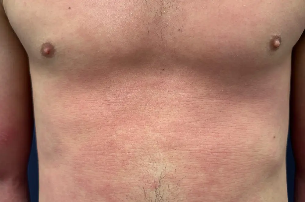 Contact dermatitis