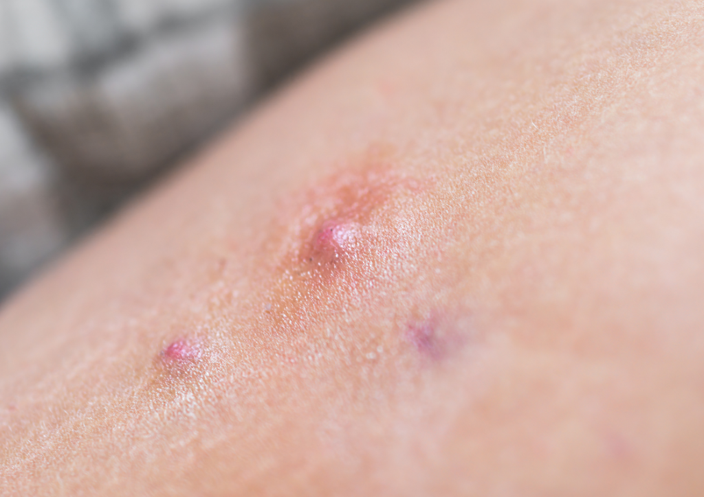 Hidradenitis suppurativa