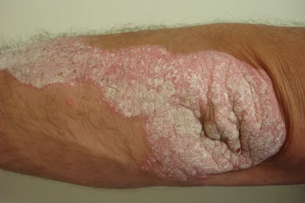 Plaque psoriasis