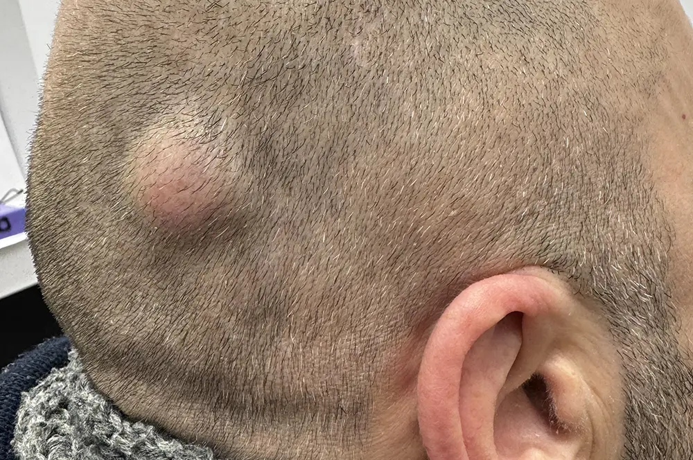 Pilar cyst on scalp