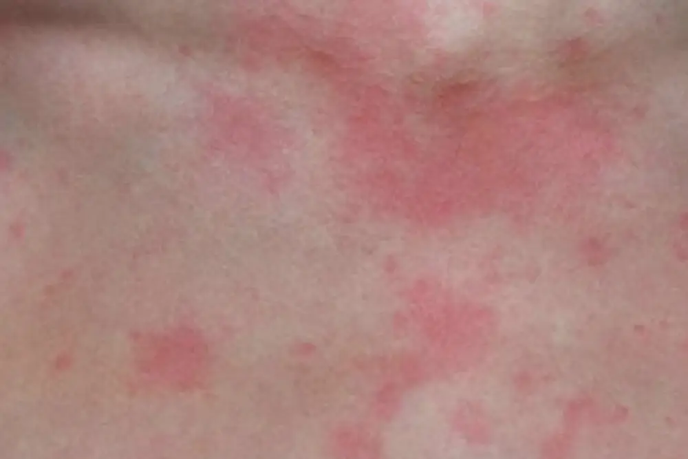 Chronic urticaria
