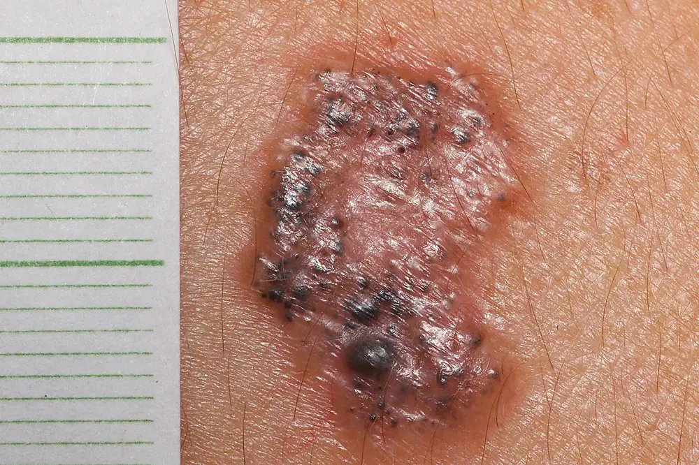 Skin cancer