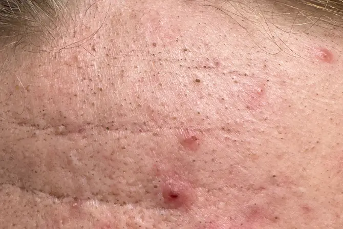 Papules