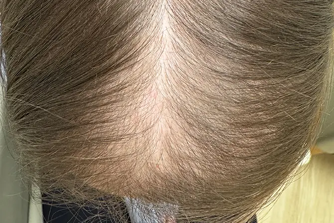 Female hair loss