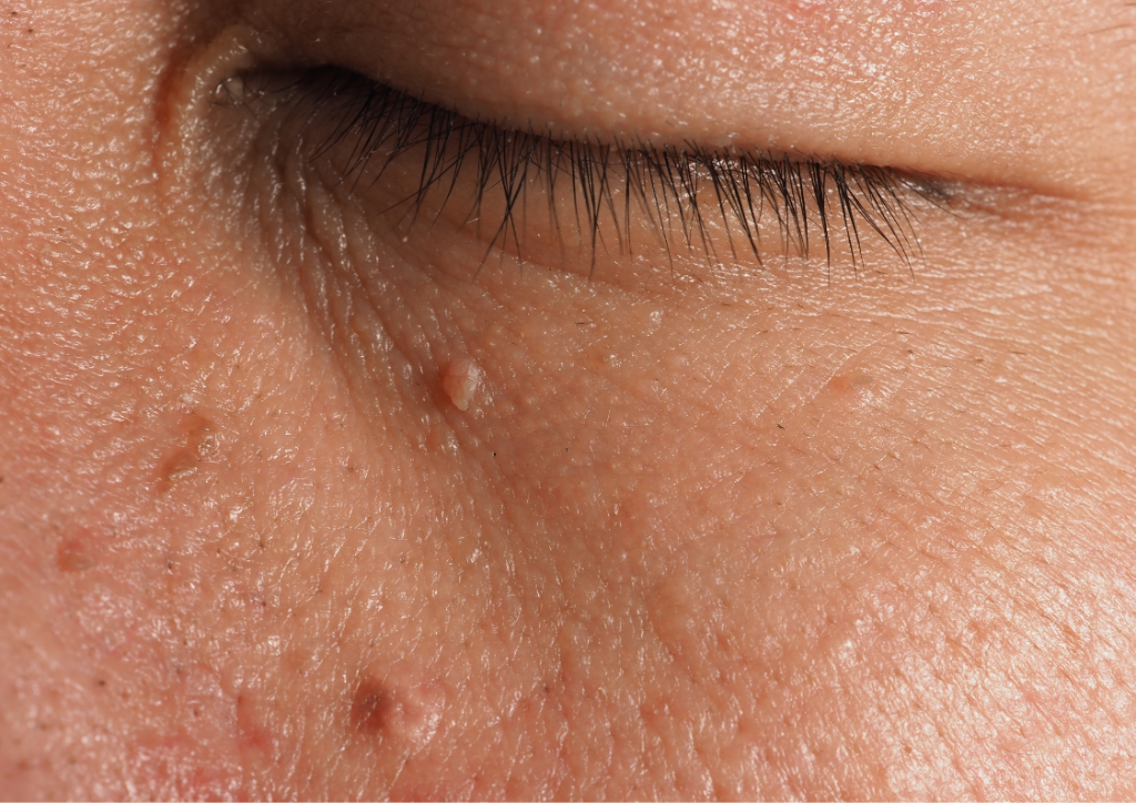 Warts and skin tags close-up
