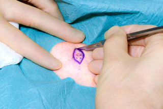 Mole removal procedure