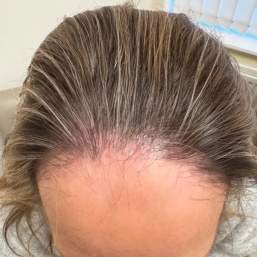 Frontal fibrosing alopecia – clinical view of hairline