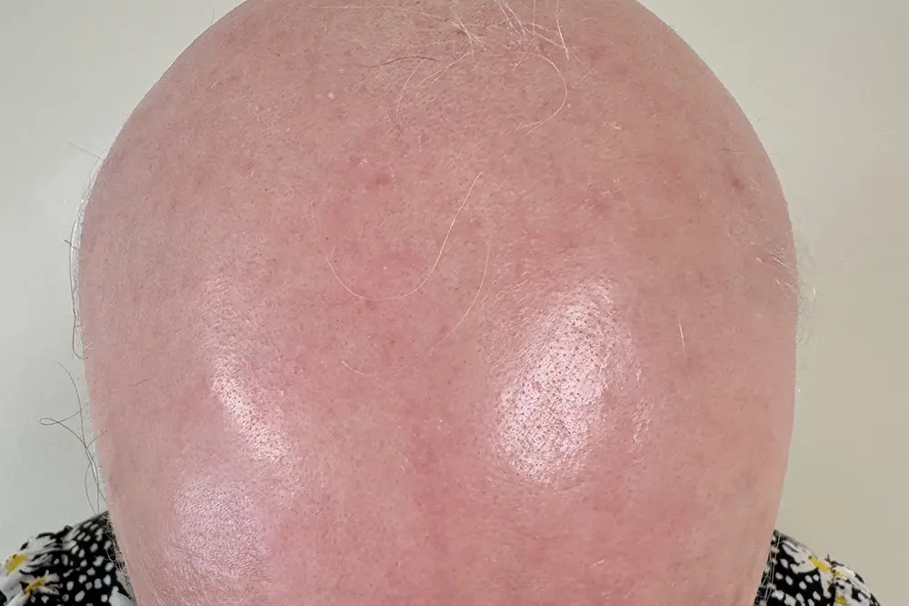 Alopecia totalis