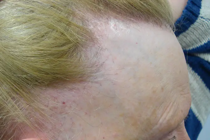 Frontal fibrosing alopecia