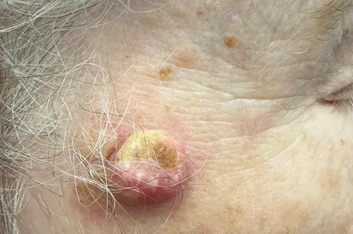 Squamous Cell Carcinoma