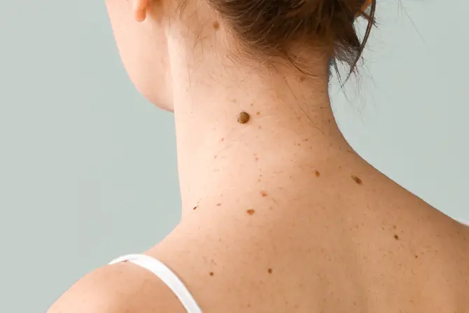 Moles