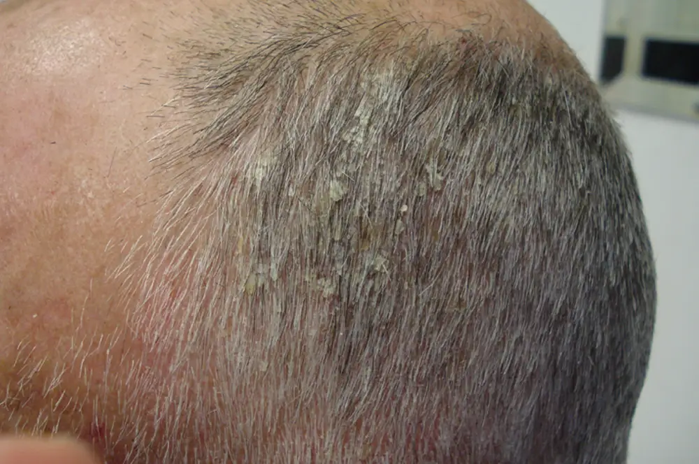 Seborrhoeic dermatitis
