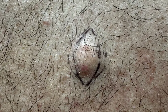 Cysts