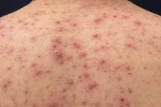 Pustules
