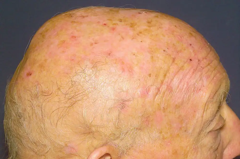 Sun damaged skin