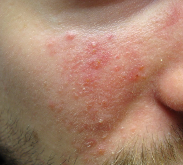 Rosacea