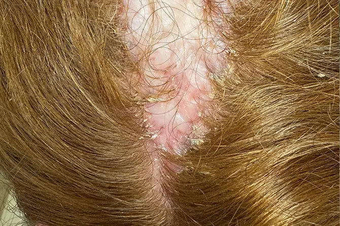 Folliculitis