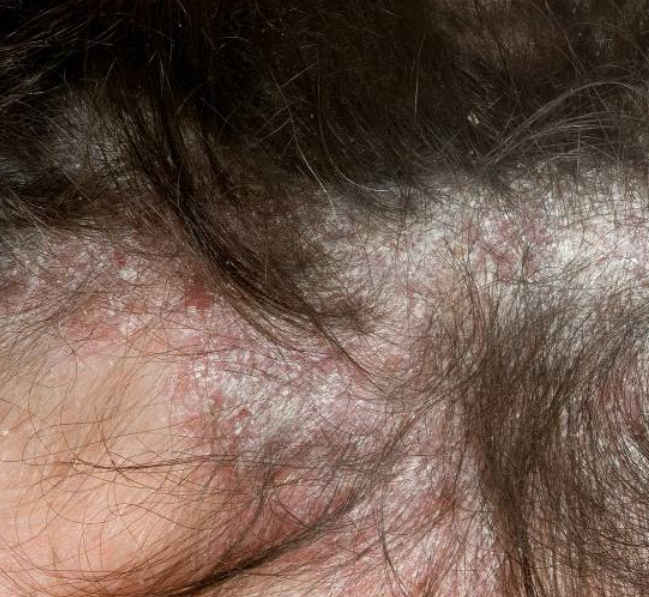 Psoriasis