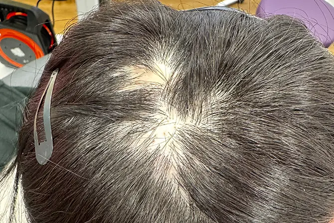 Scarring hair loss