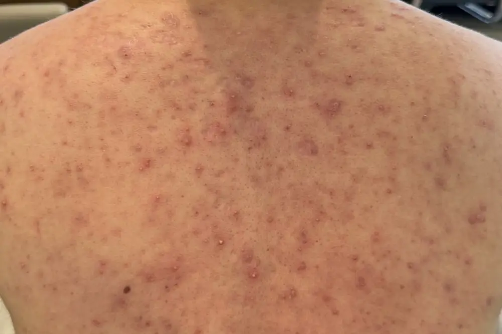 Hot tub folliculitis on the back