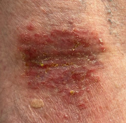 Eczema