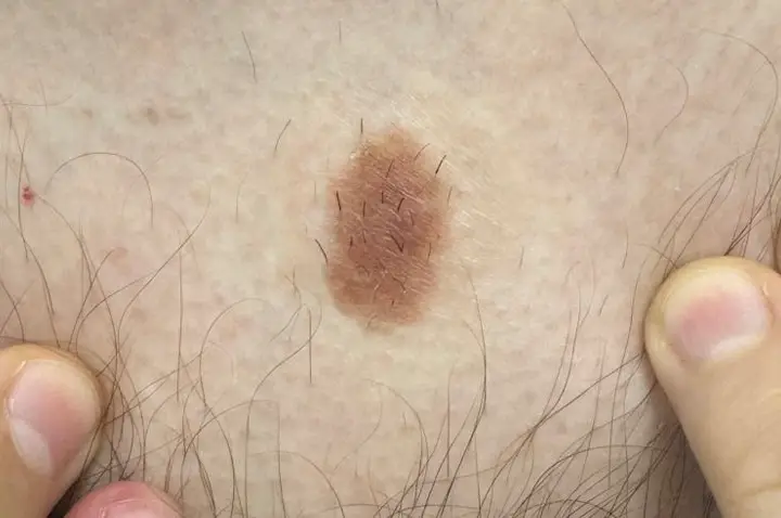 Congenital mole