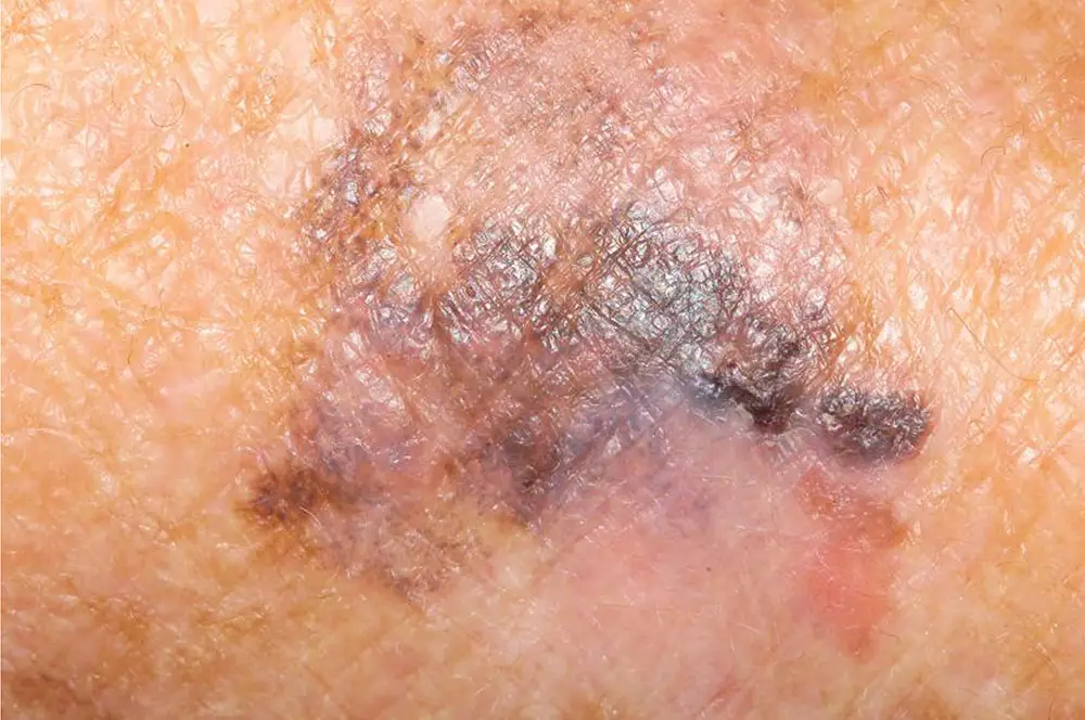 Melanoma