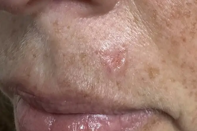 Basal Cell Carcinoma