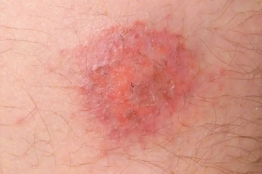 Discoid eczema
