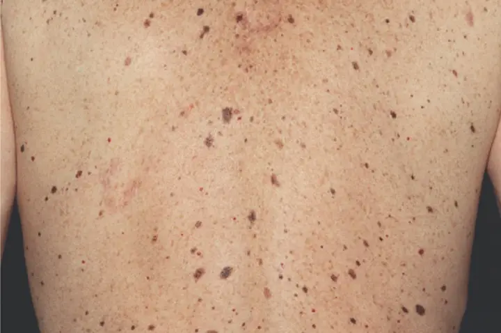 Moles